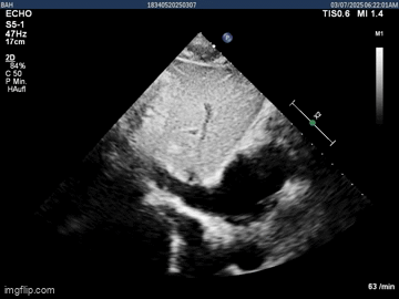 Datei:Einfluss der Vena Cava Inferior (VCI) in den rechten Vorhof.gif